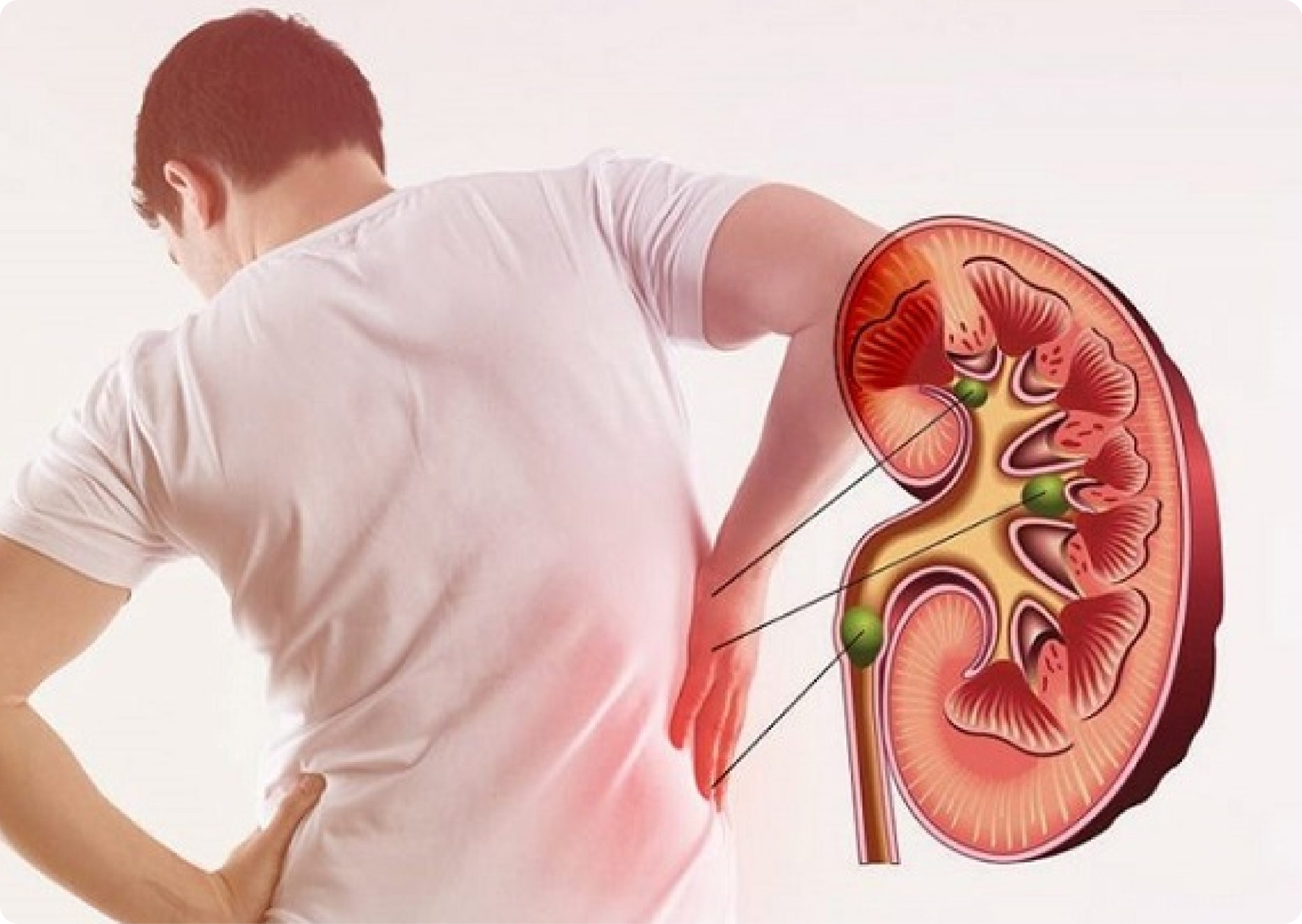 Kidney, Uretric Stone Disease