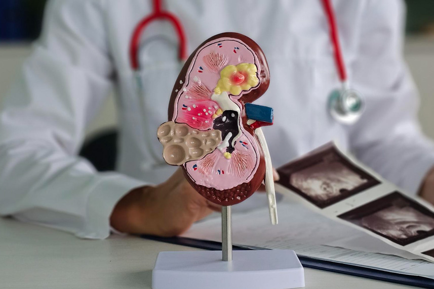 Stages of Chronic Kidney Disease – From Mild Damage to Kidney Failure