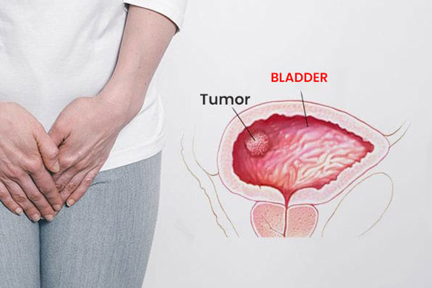 Latest Treatments for Bladder Cancer: From TURBT to Immunotherapy